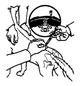 immiticide injection